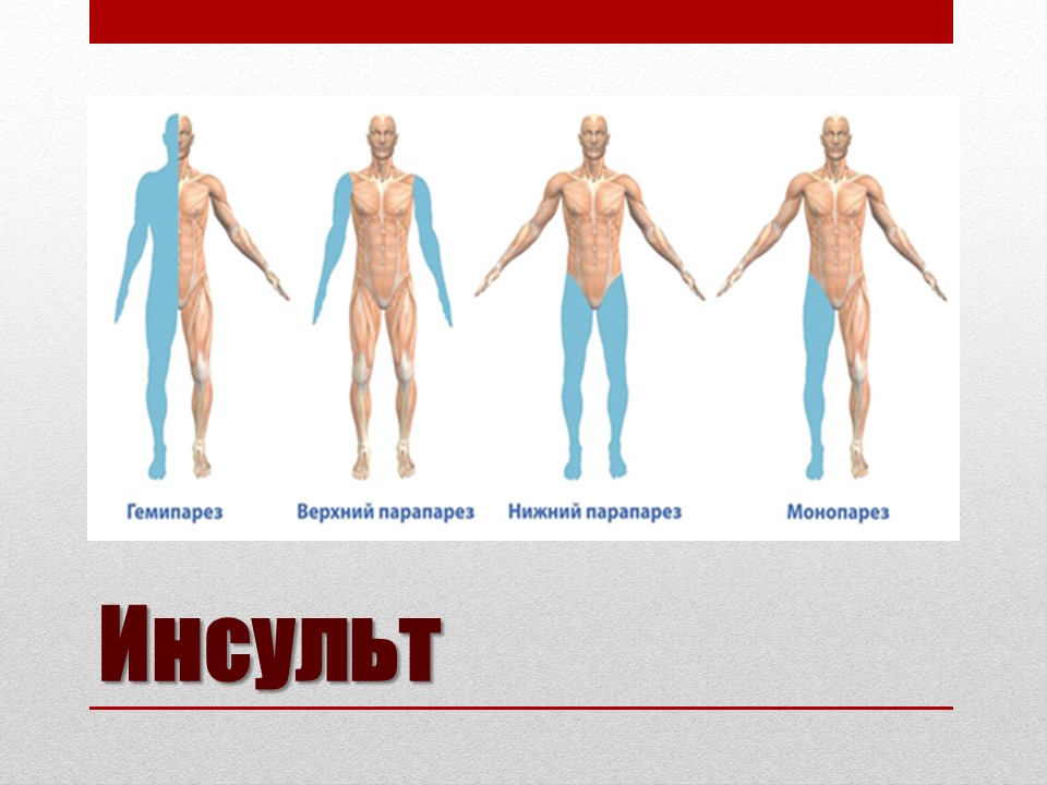 Инсульт презентация 8 класс